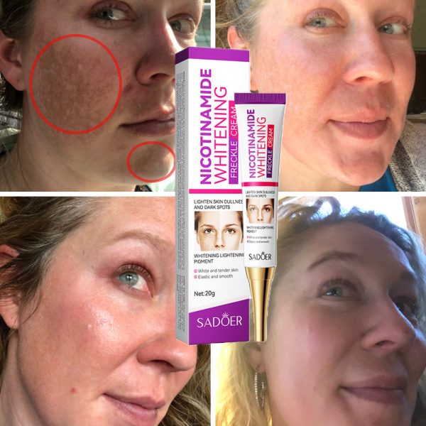 Nicotinamide Whitening Freckles Cream Remove Melasma Dark Spot