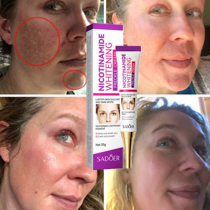 Nicotinamide Whitening Freckles Cream Remove Melasma Dark Spot